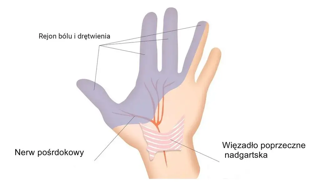 Zdjęcie Cieśń nadgarstka: Ile trwa L4 i kiedy bezpieczny powr&oacute;t?