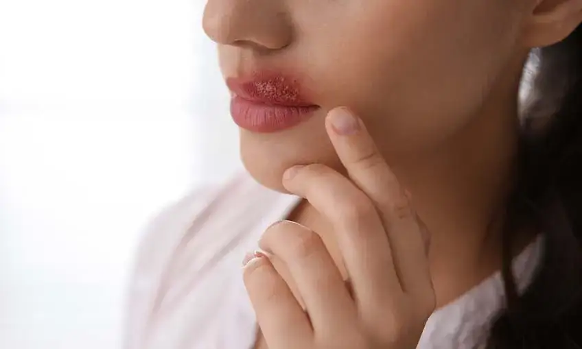 Zdjęcie Opryszczka na ustach po makijażu permanentnym – jak skutecznie leczyć?