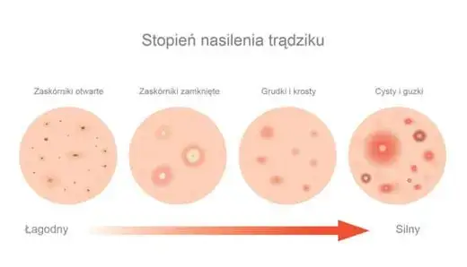 Zdjęcie Jak zapobiegać pryszczom? Skuteczny poradnik krok po kroku