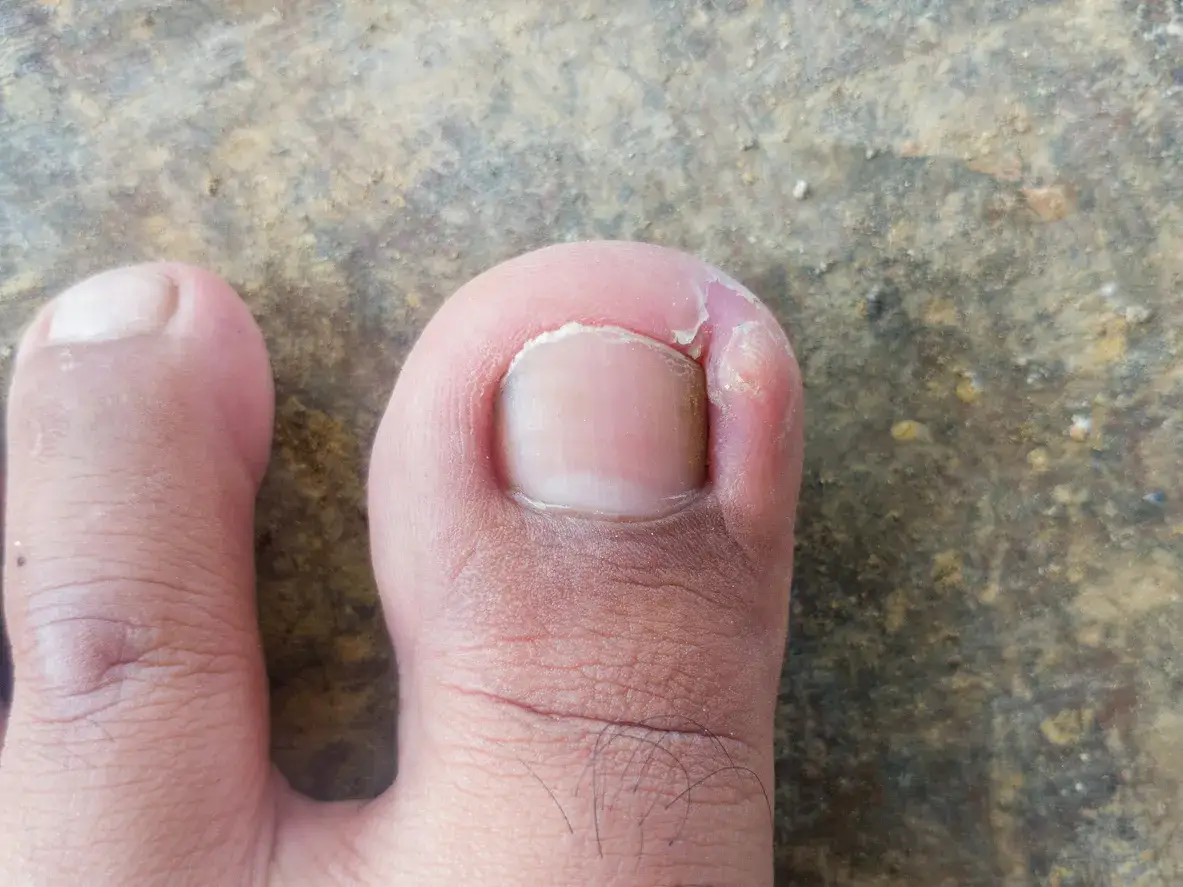 Zdjęcie Czy paznokieć może nie odrosnąć? Przyczyny, leczenie i zapobieganie problemom