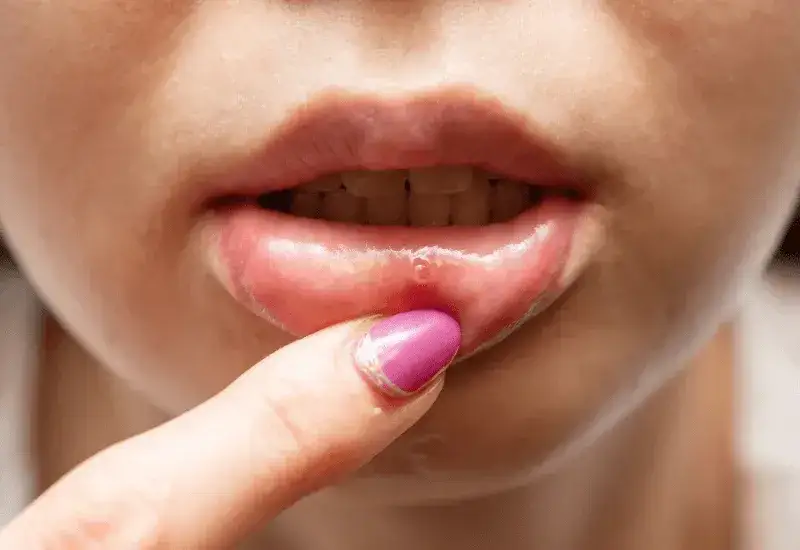 Zdjęcie Czy z zimnem można iść do dentysty? Uniknij ryzyka zarażenia