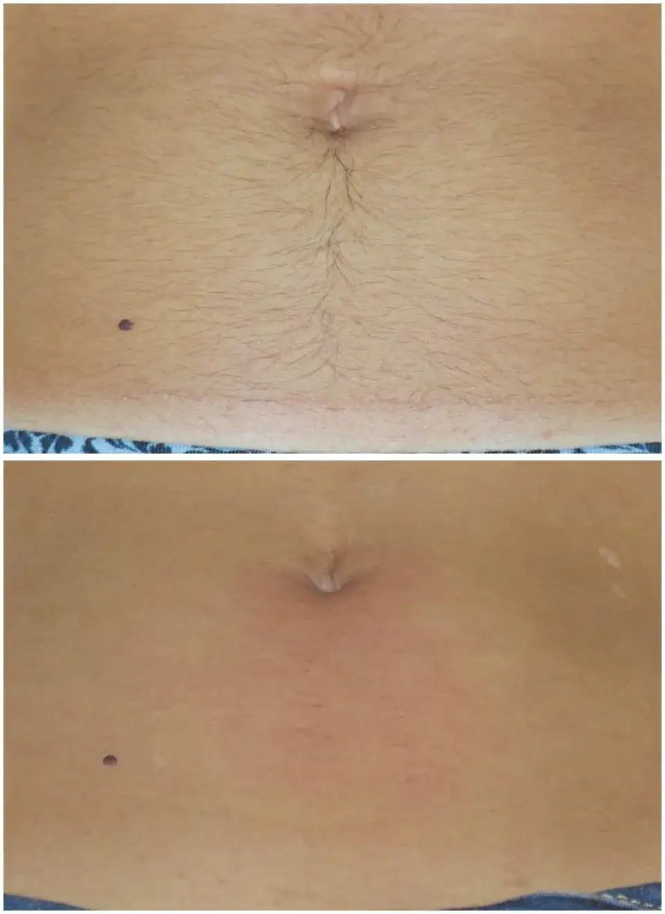 Zdjęcie Depilacja laserowa na ile starcza? Efekty i opinie z forum