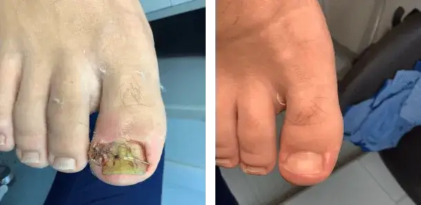 Zdjęcie Jak pozbyć się wrastającego paznokcia? Skuteczne metody i porady