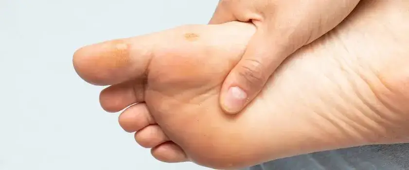 Zdjęcie Skuteczne sposoby moczenia stopy z odciskiem, które przynoszą ulgę