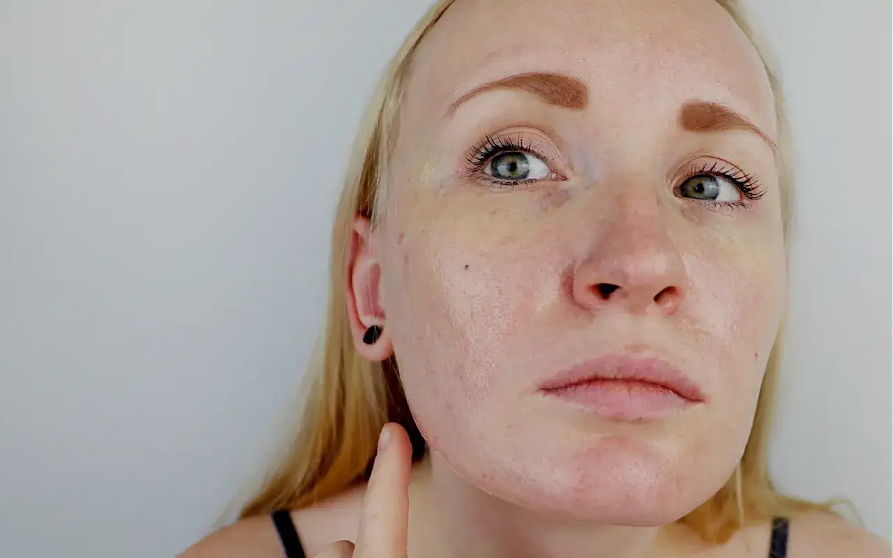 Zdjęcie Nerwica skóry objawy: Jak stres wpływa na Twoją skórę?