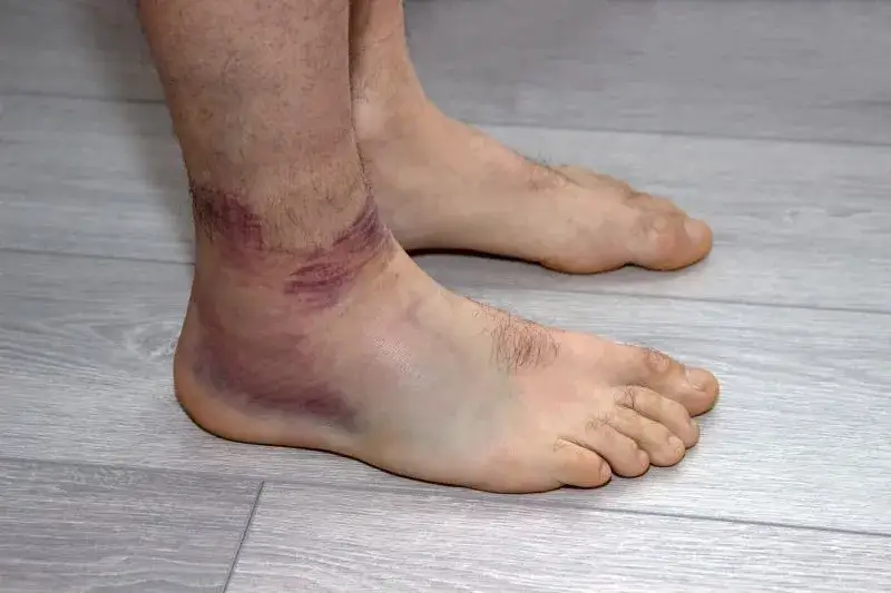 Zdjęcie Jak pozbyć się opuchlizny po skręceniu kostki i wrócić do formy