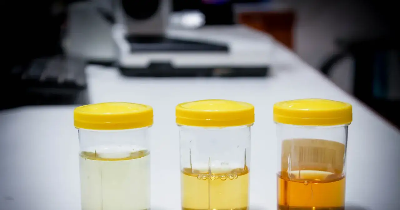 Zdjęcie Podwyższony poziom białka w moczu: co oznacza i kiedy jest groźny