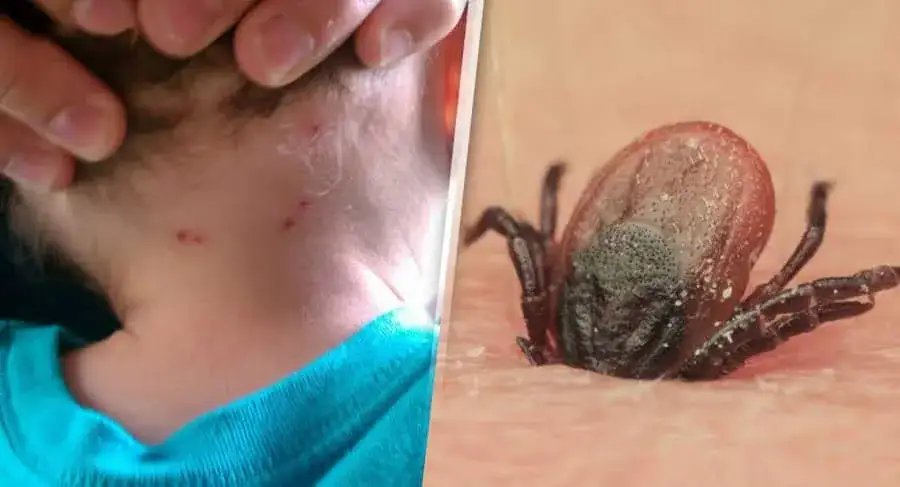 Zdjęcie Cómo matar garrapatas de forma segura y efectiva en casa y mascotas