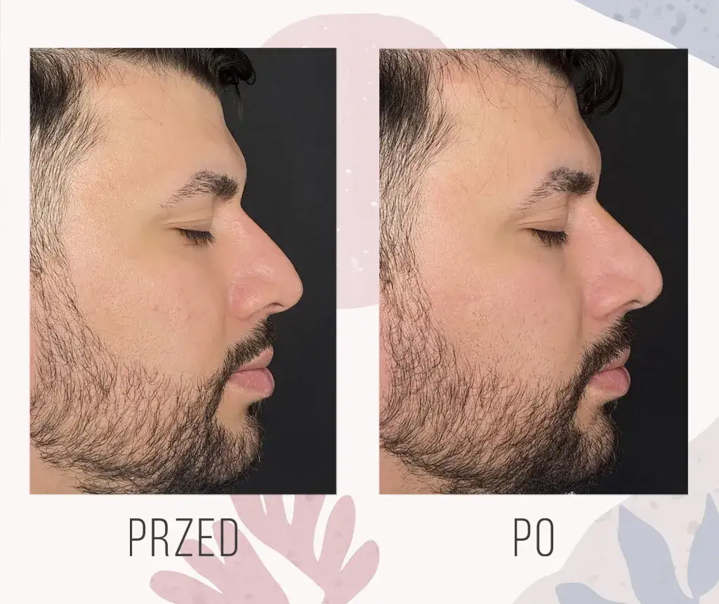 Zdjęcie Jak zmniejszyć nos kwasem hialuronowym - efekty, ryzyko i przygotowanie