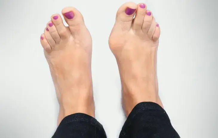 Zdjęcie Ile trwa rekonwalescencja po operacji haluksa? Poznaj prawdę o czasie gojenia