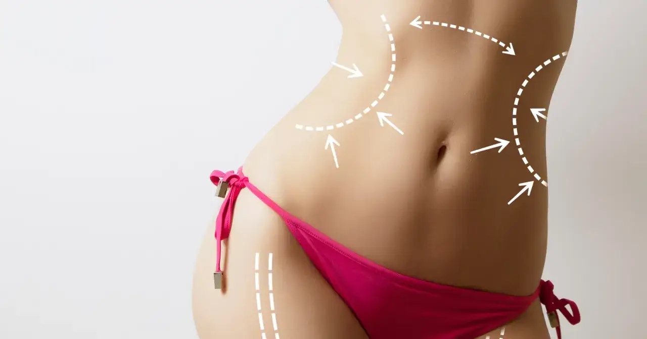 Zdjęcie Czy liposukcja ultradźwiękowa jest skuteczna? Oto co musisz wiedzieć