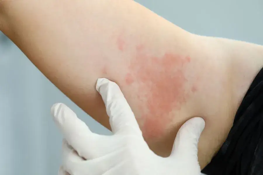 Zdjęcie Alergia na sierść kota objawy - jak je rozpoznać i co robić?