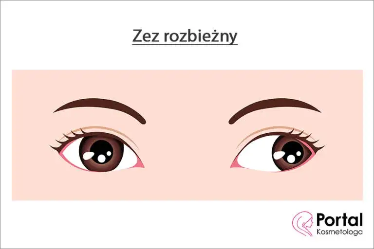 Zdjęcie Co to jest zez rozbieżny? Objawy, przyczyny i skuteczne leczenie