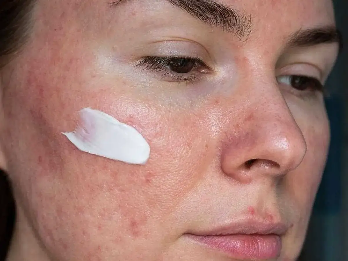 Zdjęcie Skuteczne metody na pryszcze - co naprawdę pomaga w walce z trądzikiem