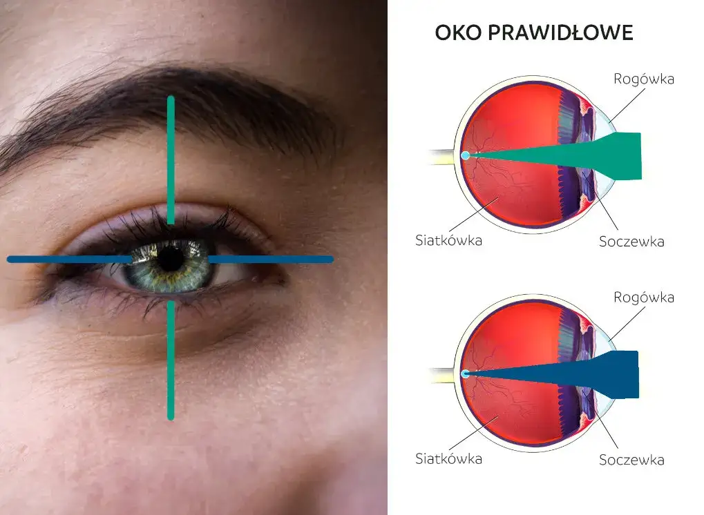 Zdjęcie Objawy uszkodzenia wzroku laserem - poznaj sygnały alarmowe i skutki