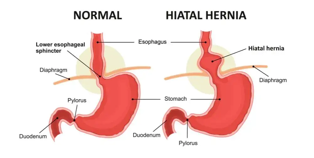 Zdjęcie Hernia de hiato: Identifica sus s&iacute;ntomas y cu&aacute;ndo buscar ayuda.