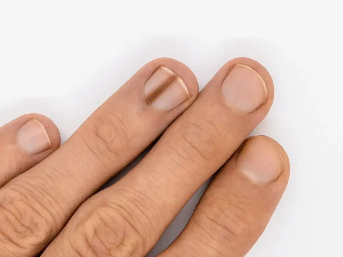 Zdjęcie Czarna kreska na paznokciu – co to oznacza i kiedy się martwić?
