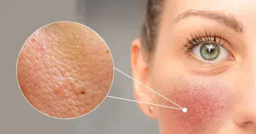 Zdjęcie Cómo combatir la piel de naranja en el rostro y mejorar tu piel