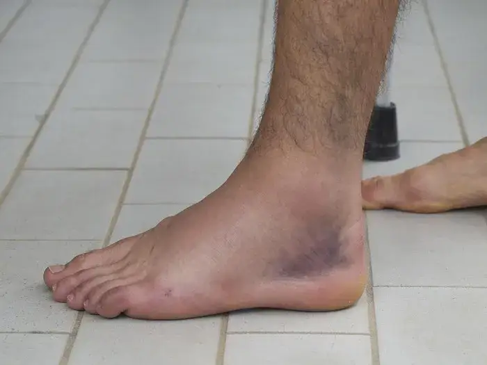 Zdjęcie Czy skręcenie kostki boli? Objawy i sposoby na złagodzenie bólu