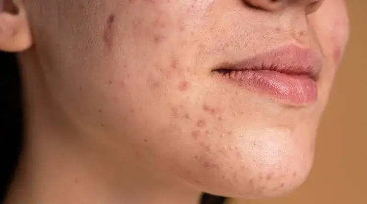 Zdjęcie Die Geheimnisse der Gesichtshaut: Tipps für empfindliche und trockene Haut