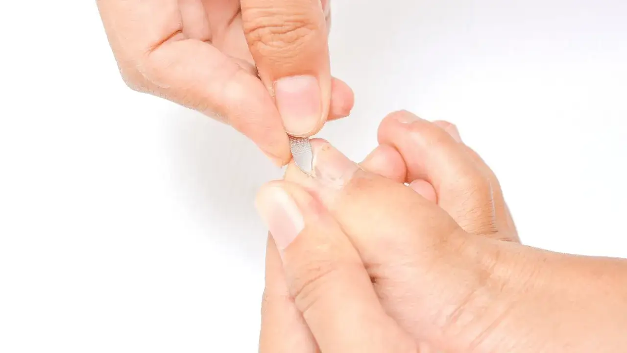 Zdjęcie Jak wygląda wrośnięty paznokieć i jak uniknąć bólu oraz powikłań