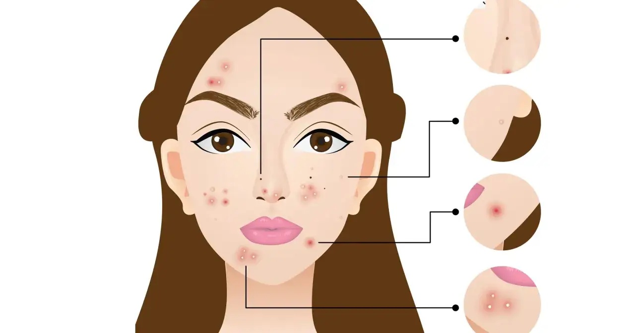 Zdjęcie Pryszcze na twarzy znaczenie: co mówią o twoim zdrowiu?