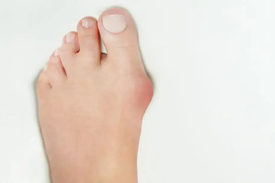 Zdjęcie Czy haluksy odrastają? Odkryj prawdę o nawrotach po operacji