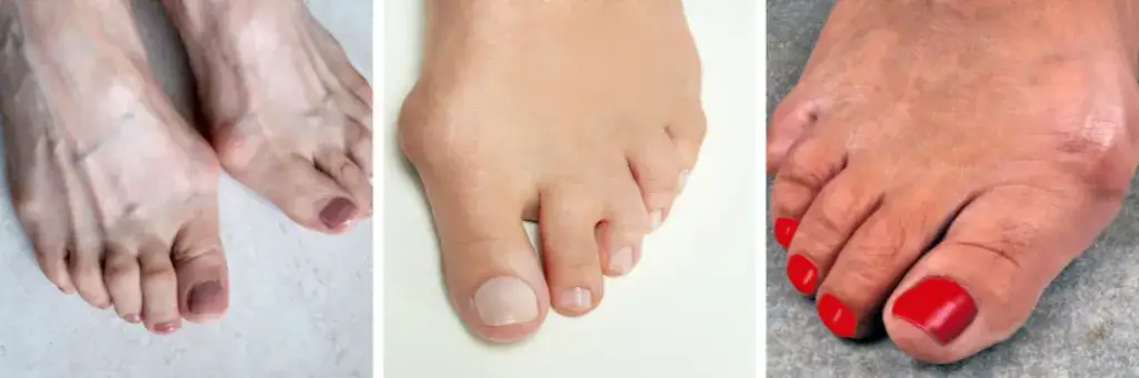Zdjęcie Jaki lekarz leczy haluksy? Klucz do skutecznego leczenia bólu stóp