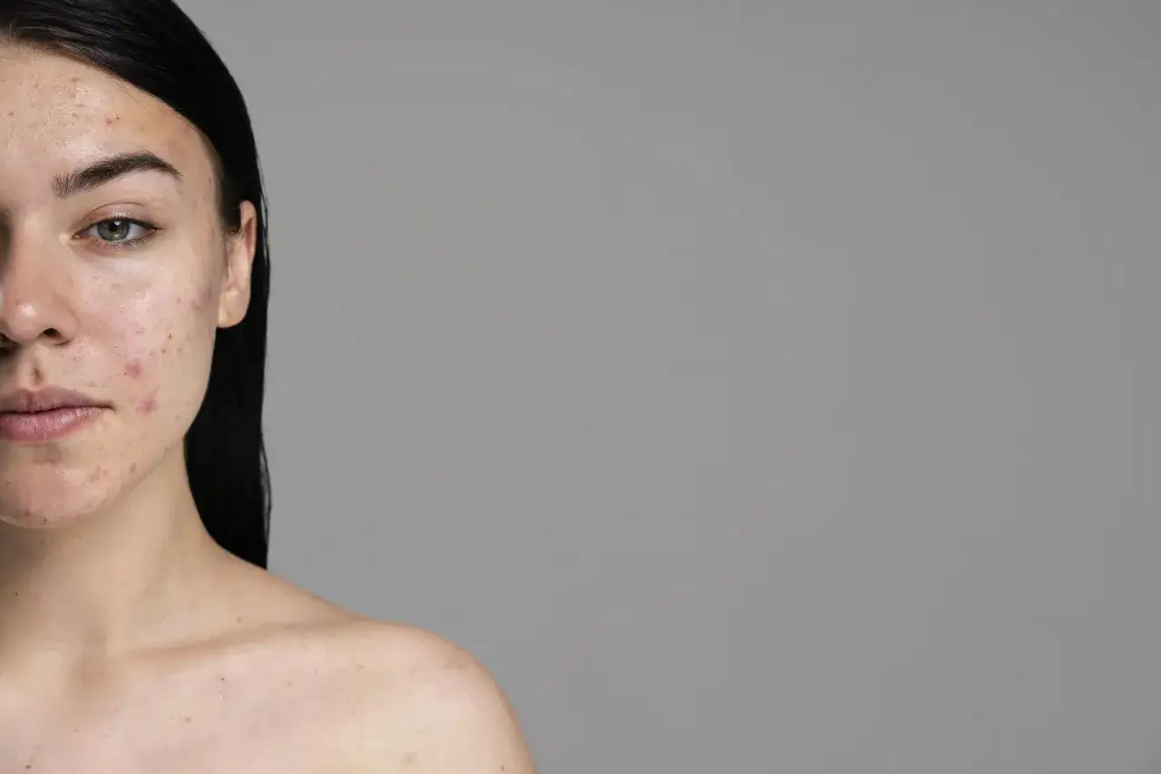 Zdjęcie Jak pozbyć się blizn po pryszczach - skuteczne metody i porady