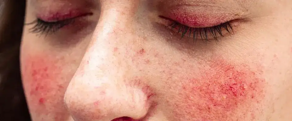Zdjęcie Skuteczne sposoby na pryszcze w ciąży - bezpieczne metody pielęgnacji