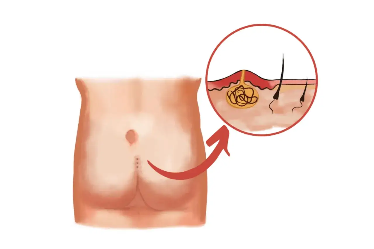 Zdjęcie Torbiel włosowa jaki lekarz - Jak uniknąć poważnych komplikacji?