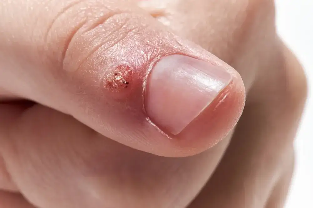 Zdjęcie Wirus HPV: objawy i zdjęcia – jak rozpoznać kłykciny i brodawki?