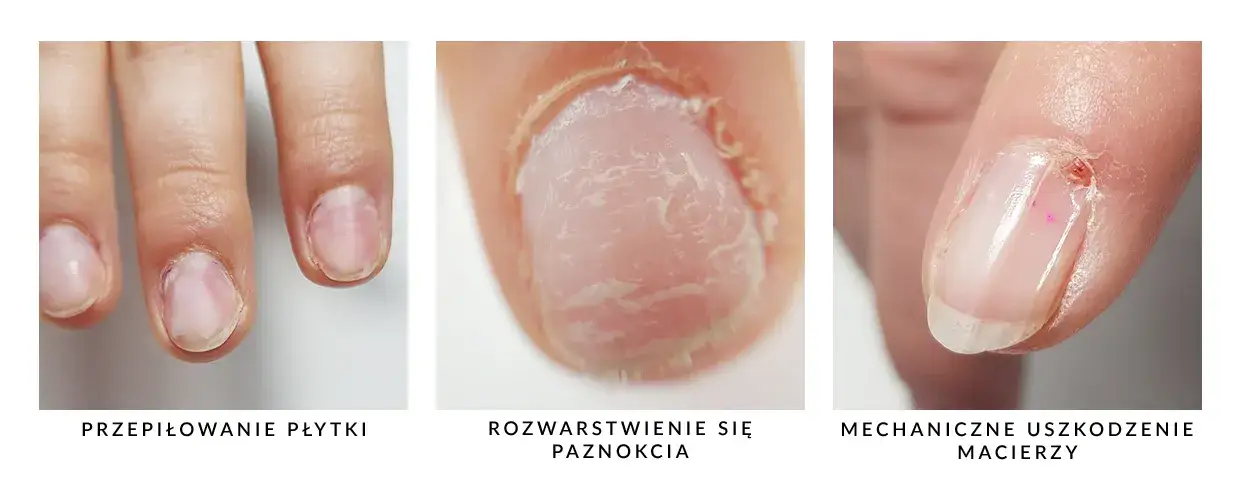 Zdjęcie Jak odbudować macierz paznokcia i przywrócić jej zdrowie?