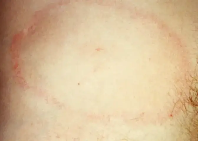 Zdjęcie Czy rumień po kleszczu boli? Poznaj niepokojące objawy boreliozy