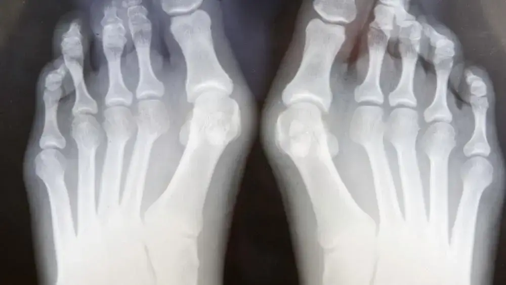 Zdjęcie Do jakiego lekarza z haluksami? Kluczowe informacje o specjalistach