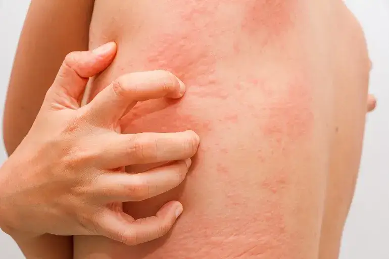 Zdjęcie Uczulenie na salicylany jakie leki: bezpieczne alternatywy dla zdrowia