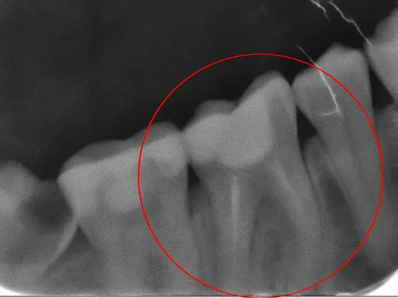 Zdjęcie Skutki uboczne leczenia kanałowego zęba: ból, obrzęk i powikłania