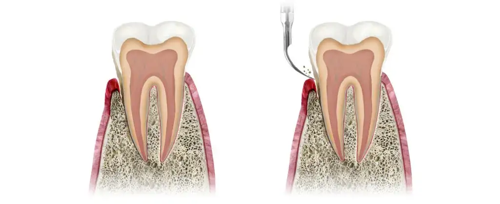 Zdjęcie Jak skutecznie usunąć ropę na dziąśle i uniknąć powikłań