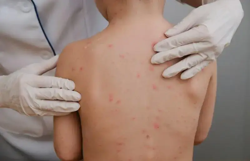 Zdjęcie Świnka objawy: jak rozpoznać chorobę i uniknąć poważnych komplikacji