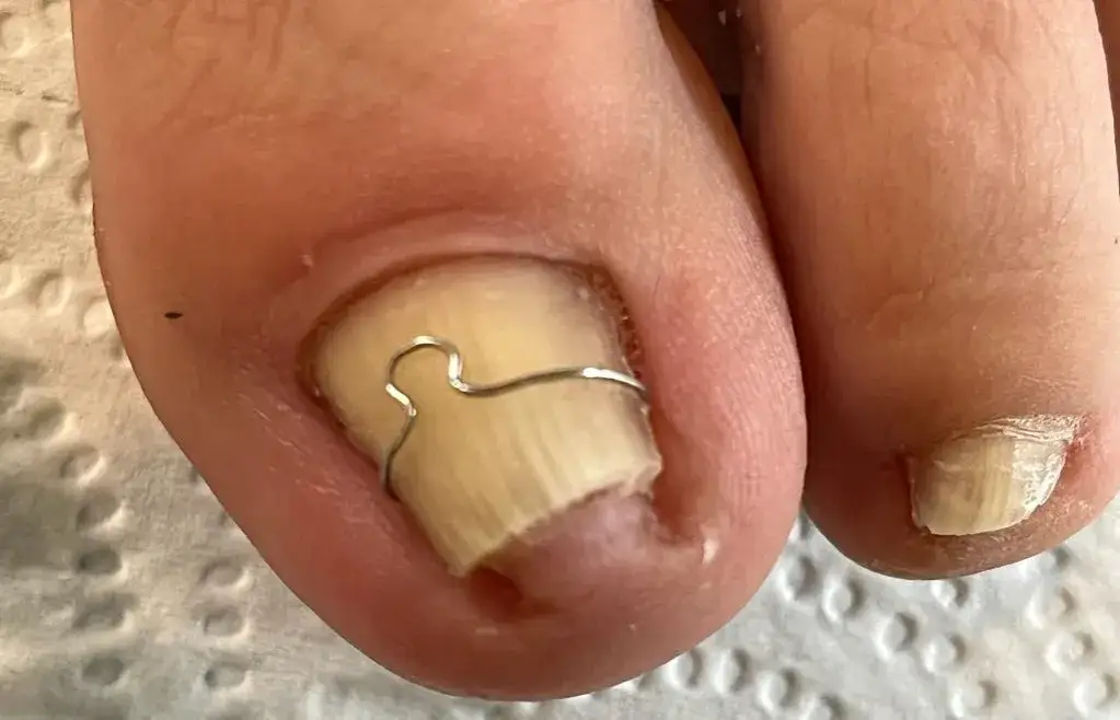 Zdjęcie Klamra na paznokieć czy boli? Odkryj prawdę o bólu podczas zabiegu