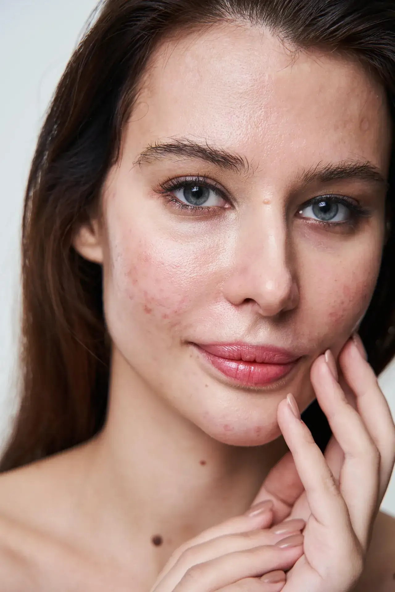 Zdjęcie Jak pozbyć się blizn po pryszczach domowe sposoby, które działają