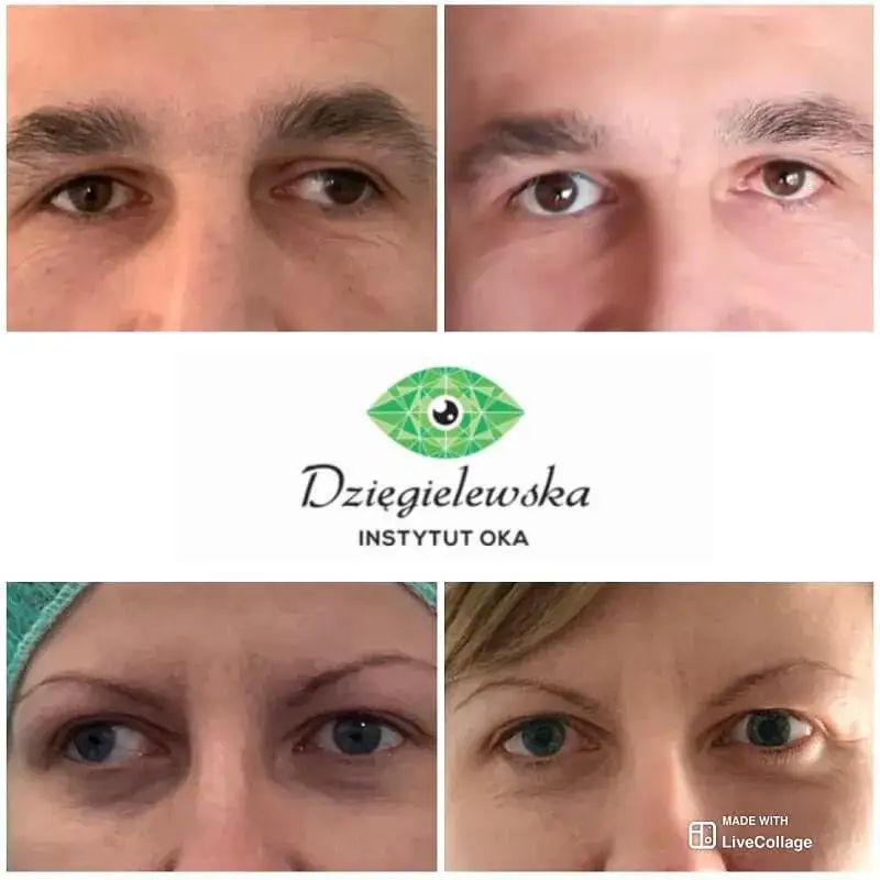 Zdjęcie Czy zez po operacji wraca? Poznaj szanse i sposoby na uniknięcie nawrotu