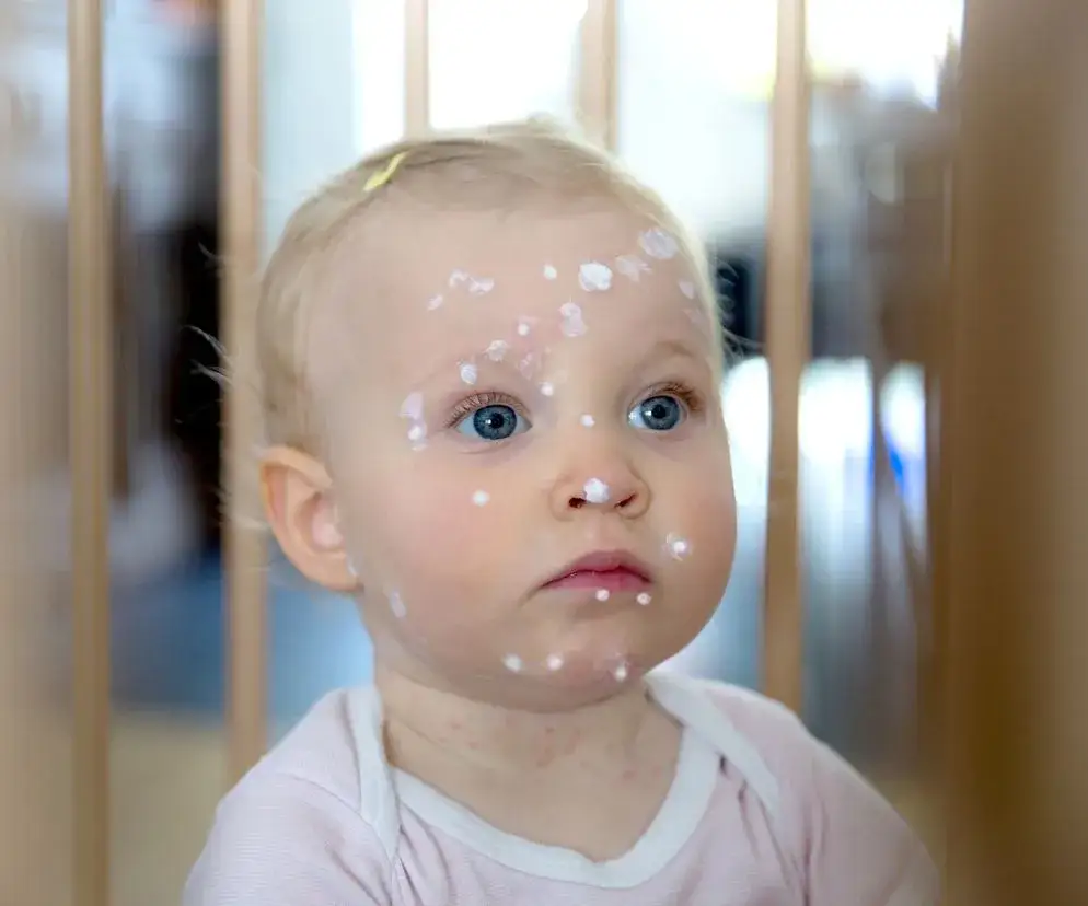 Zdjęcie Jak myć dziecko z ospą, aby uniknąć podrażnień i bólu skóry