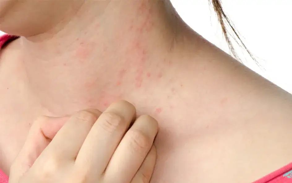 Zdjęcie Allergie Symptome: So erkennen Sie gef&auml;hrliche Reaktionen rechtzeitig