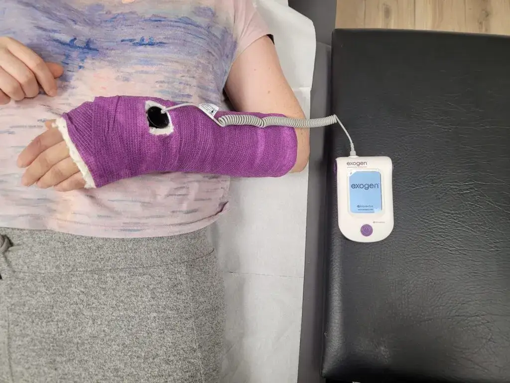Zdjęcie Złamanie łokcia ile gips &ndash; ile czasu musisz nosić gips?