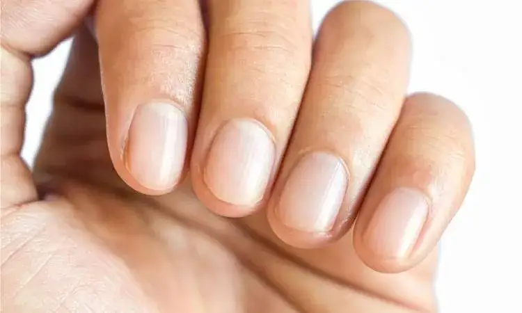Zdjęcie Co mogą oznaczać podłużne bruzdy na paznokciach i ich zdrowotne skutki