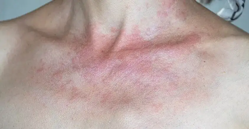 Zdjęcie Alergia na słońce objawy: Zobacz, jak rozpoznać niebezpieczne reakcje
