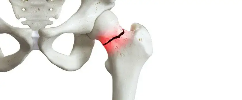 Zdjęcie Sklerotyzacja stropu panewki: co to znaczy i jak wpływa na zdrowie?