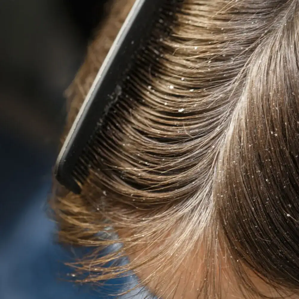 Zdjęcie Na czym polega zjawisko łojotoku i jak uniknąć jego skutków?