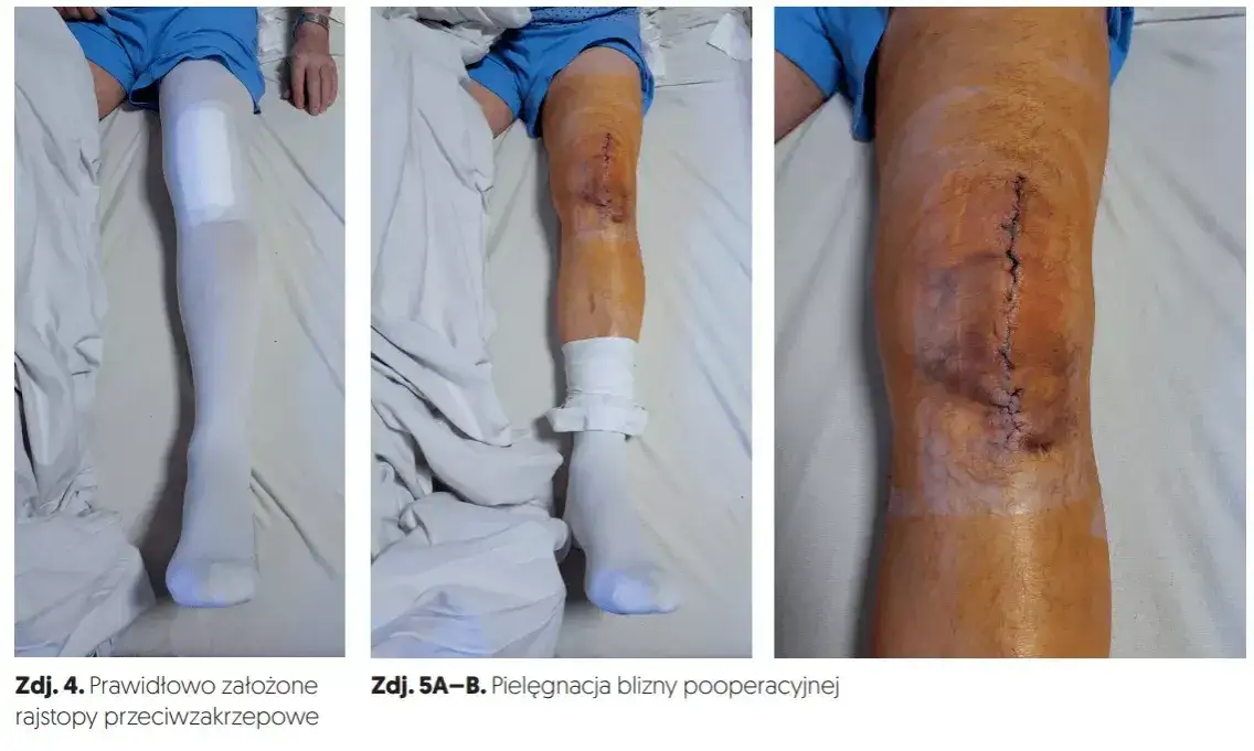 Zdjęcie Ile trwa rehabilitacja po endoprotezie kolana? Poznaj kluczowe fakty